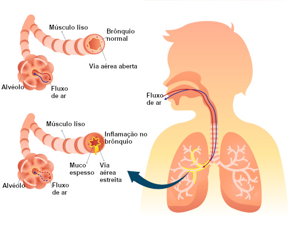 A inflamação dos brônquios é denominada bronquite.