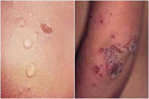 Impetigo bolhoso e impetigo comum, respectivamente