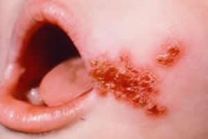 Criança acometida pelo impetigo